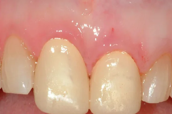 What is crown lengthening? 2026 What is crown lengthening? 2026