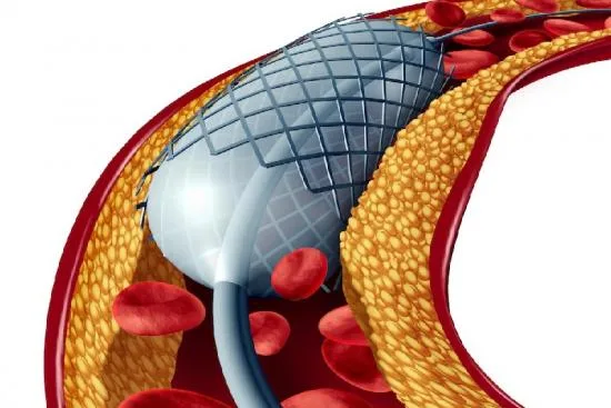 ¿Cuándo se realiza una angioplastia coronaria? 2026 ¿Cuándo se realiza una angioplastia coronaria? 2026