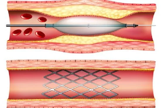Etapas de la angioplastia coronaria en Turquía 2026 Etapas de la angioplastia coronaria en Turquía 2026
