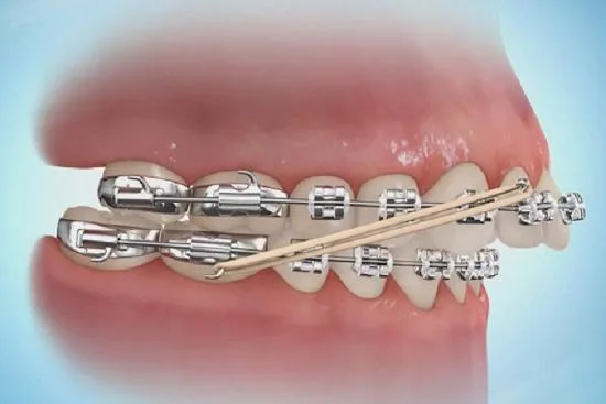 Pourquoi porter un appareil orthodontique ? 2026 Pourquoi porter un appareil orthodontique ? 2026