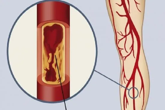 Symptoms of PAD 2026 Symptoms of PAD 2026