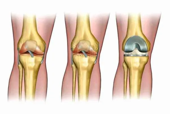 osteoarthritis treatment in turkey price
