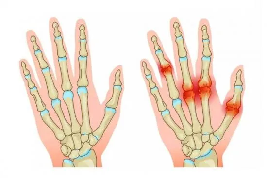 arthritis treatment