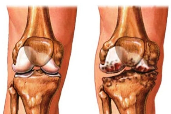Osteoarthritis treatment Turkey Osteoarthritis treatment Turkey