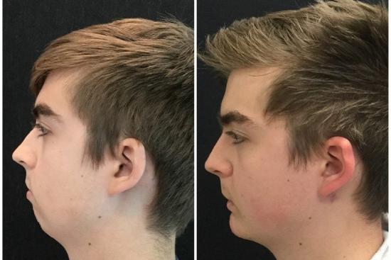 Chin augmentation Chin augmentation