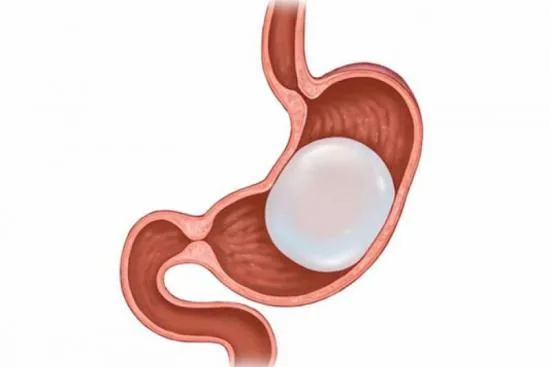 Types des ballons intragastriques 2026 Types des ballons intragastriques 2026