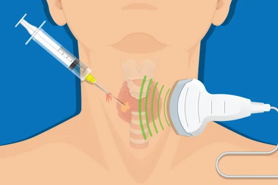 Thyroid biopsy procedure in Turkey 2026 Thyroid biopsy procedure in Turkey 2026