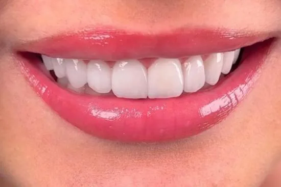 Price of teeth whitening in Turkey 2026 Price of teeth whitening in Turkey 2026