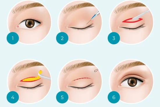 Blepharoplasty process (upper and lower) 2026