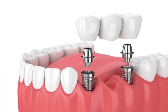Tipos de puentes dentales disponibles en Turquía 2026 Tipos de puentes dentales disponibles en Turquía 2026