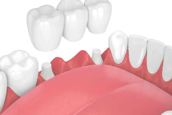 Proceso de instalación de un puente dental en Turquía 2026 Proceso de instalación de un puente dental en Turquía 2026
