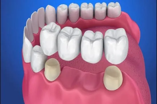 Ventajas de los puentes dentales en Turquía 2026 Ventajas de los puentes dentales en Turquía 2026