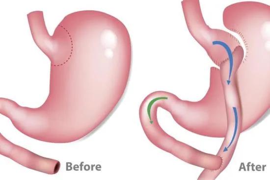 What is a gastric bypass? 2026 What is a gastric bypass? 2026