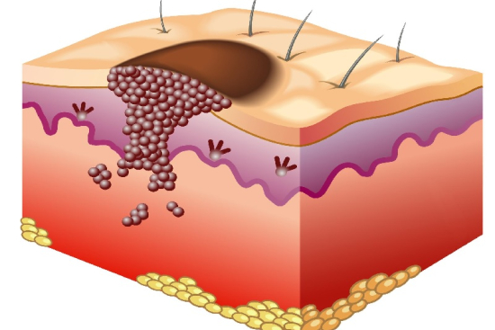 Skin cancer treatment Turkey Skin cancer treatment Turkey