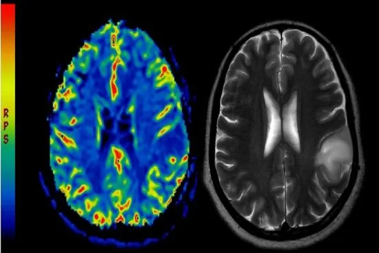 Cómo se diagnostican los tumores cerebrales 2026