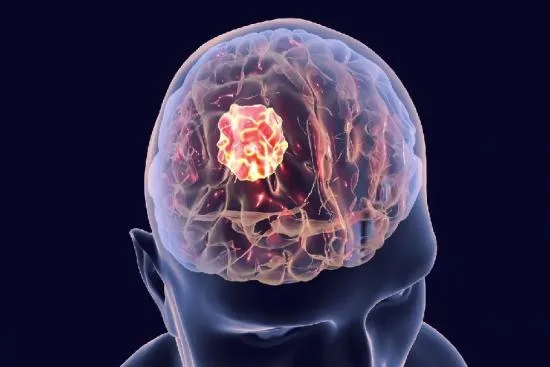 Síntomas de los tumores cerebrales 2026