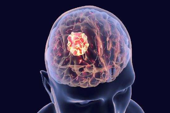 Tratamiento del cáncer de cerebro
