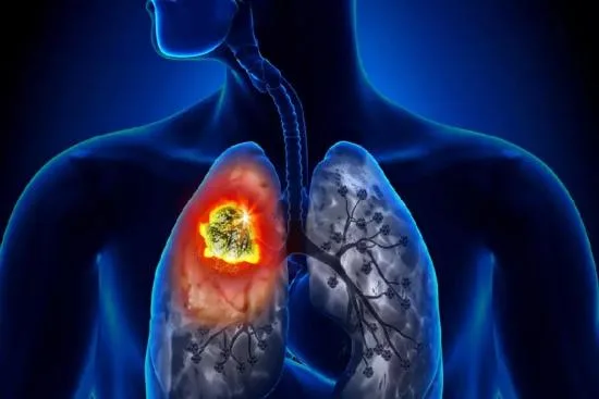 Forms of lung cancer 2026 Forms of lung cancer 2026