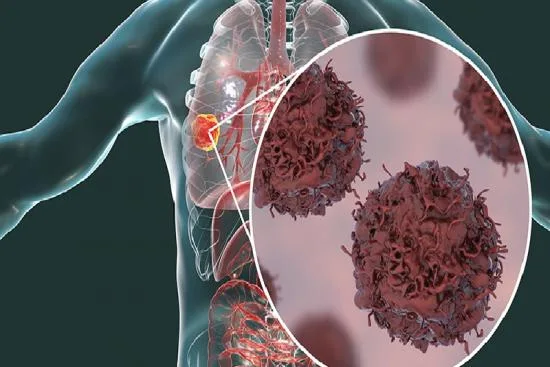 Lung cancer: Causes & risk factors 2026 Lung cancer: Causes & risk factors 2026