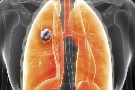 Diagnosis of lung cancer 2026 Diagnosis of lung cancer 2026