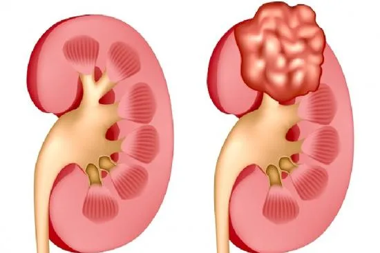 Risk factors for kidney cancer 2026 Risk factors for kidney cancer 2026