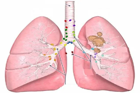 Lung cancer treatment options in Turkey 2026 Lung cancer treatment options in Turkey 2026