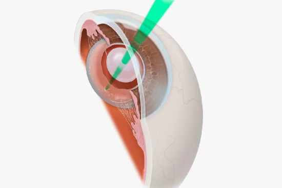 Recovery After YAG Laser Capsulotomy in Turkey 2026 Recovery After YAG Laser Capsulotomy in Turkey 2026