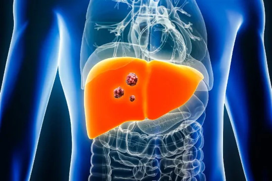 Diagnóstico del cáncer de hígado en Turquía 2026