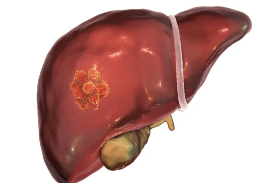 Cancer du foie : reconnaître les risques et agir à temps 2026 Cancer du foie : reconnaître les risques et agir à temps 2026