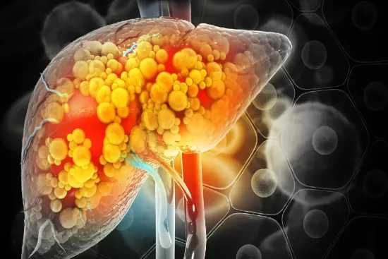 Liver cancer treatments in Turkey 2026 Liver cancer treatments in Turkey 2026