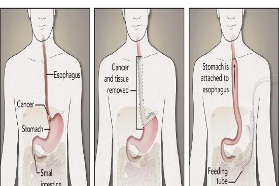 Esophageal cancer treatments available in Turkey 2026 Esophageal cancer treatments available in Turkey 2026