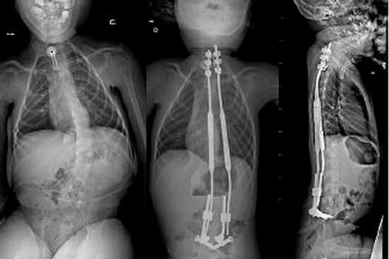Diagnóstico de la escoliosis en Turquía 2026 Diagnóstico de la escoliosis en Turquía 2026