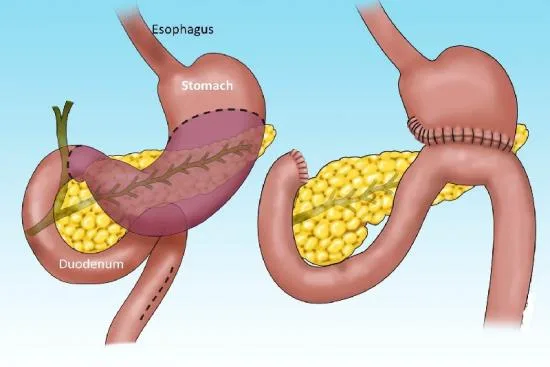 cáncer de estómago