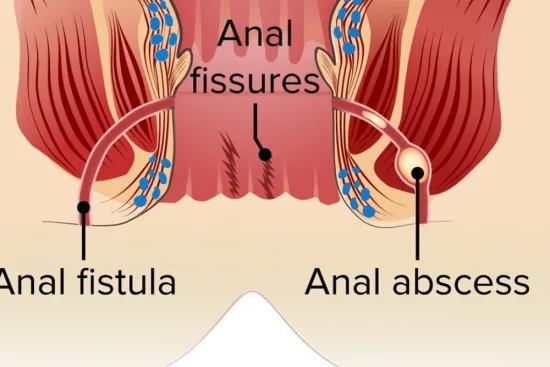 Treatment of perianal abscess in Turkey 2026 Treatment of perianal abscess in Turkey 2026