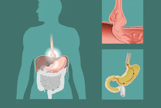 Causes des hernies hiatales Causes des hernies hiatales