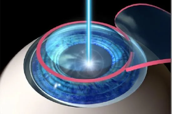 Opération au LASIK Opération au LASIK