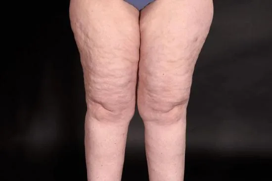 Why lipedema surgery might be right for you 2026
