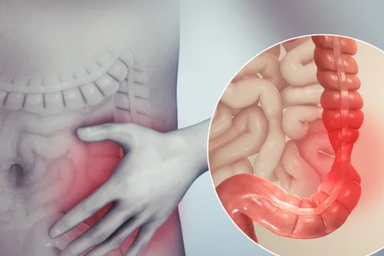 Chirurgie pour la constipation chronique Chirurgie pour la constipation chronique