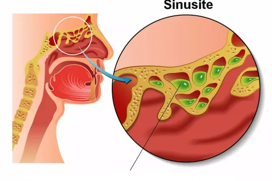 Diagnóstico de sinusitis en Turquía: pasos y herramientas 2026