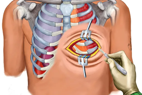 thoracic surgery in Turkey thoracic surgery in Turkey