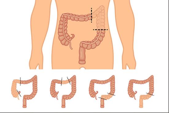 Colectomy