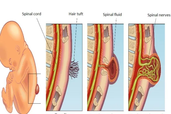 Spina Bifida 