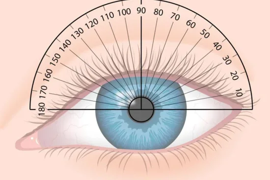 Compound myopic astigmatism Compound myopic astigmatism