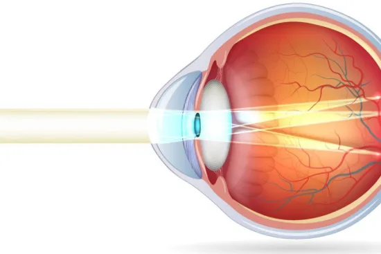 Myopic astigmatism Myopic astigmatism