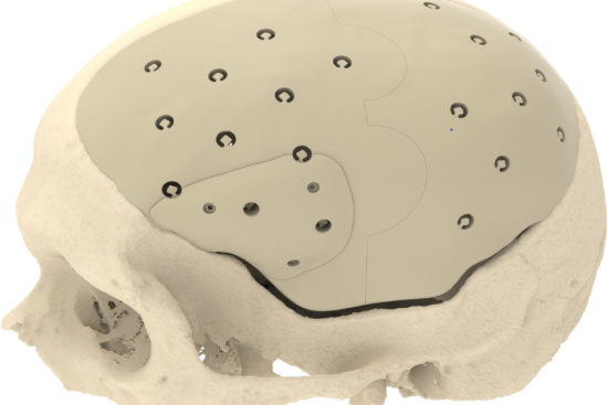 Cranioplasty