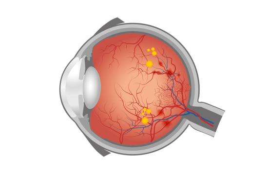 Diabetic Retinopathy Treatment