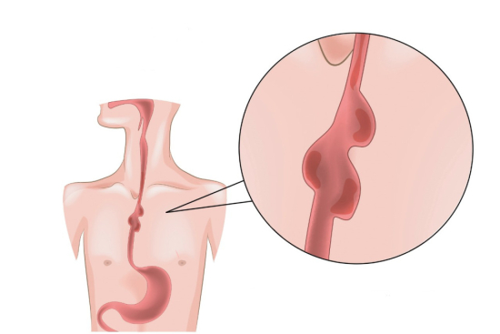 Esophageal diverticula surgery