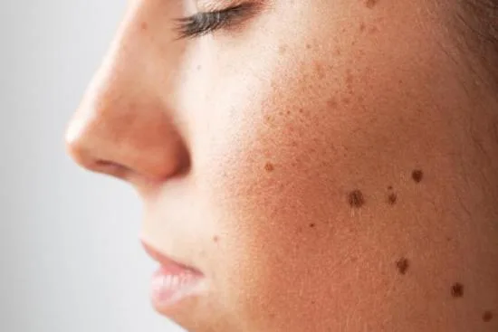 ¿Cuándo debo consultar a un dermatólogo por un lunar? 2026 ¿Cuándo debo consultar a un dermatólogo por un lunar? 2026