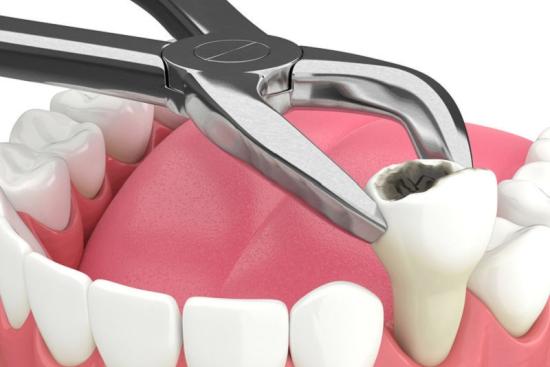 Dental extraction Turkey