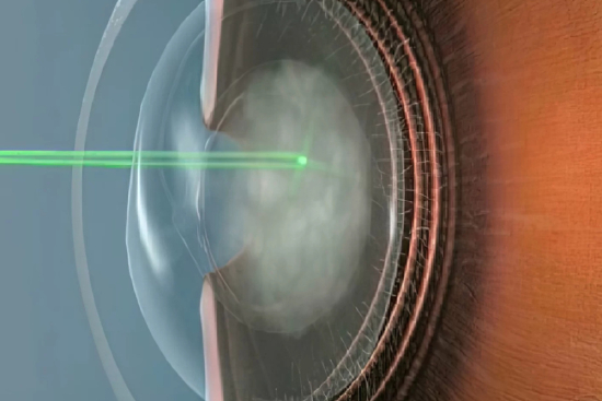 YAG laser capsulotomy